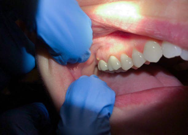Best Urgent Care for Lost Fillings or Crowns in Wilmington, DE